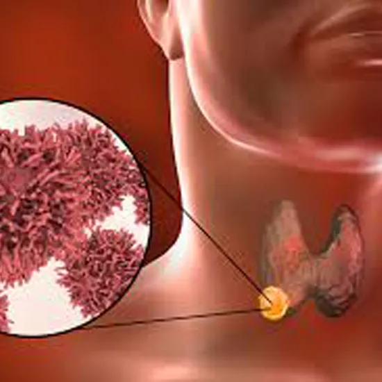 Medullary Thyroid Cancer Test